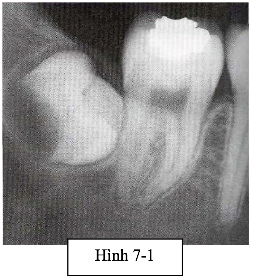 Phẫu thuật lấy mầm răng